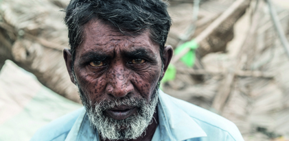 Cataract Surgery for Pakistanis