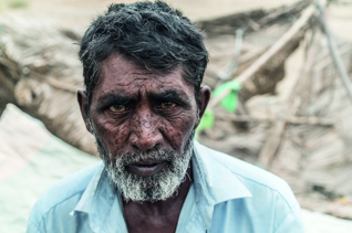 Cataract Surgery for Pakistanis