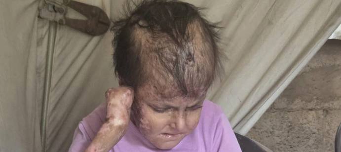 Reema, who lives with Epidermolysis Bullosa, in Gaza.