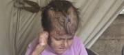 Reema, who lives with Epidermolysis Bullosa, in Gaza.